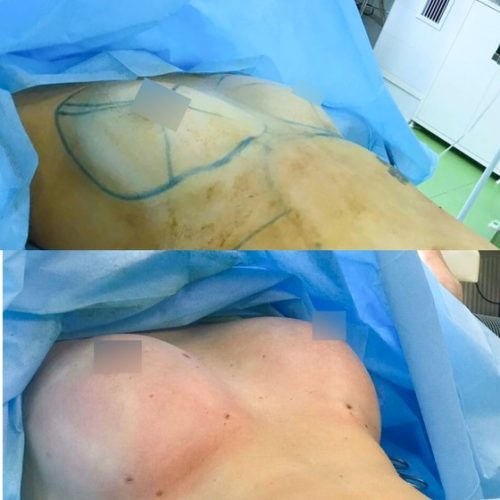 Липофилинг груди - фото до и после