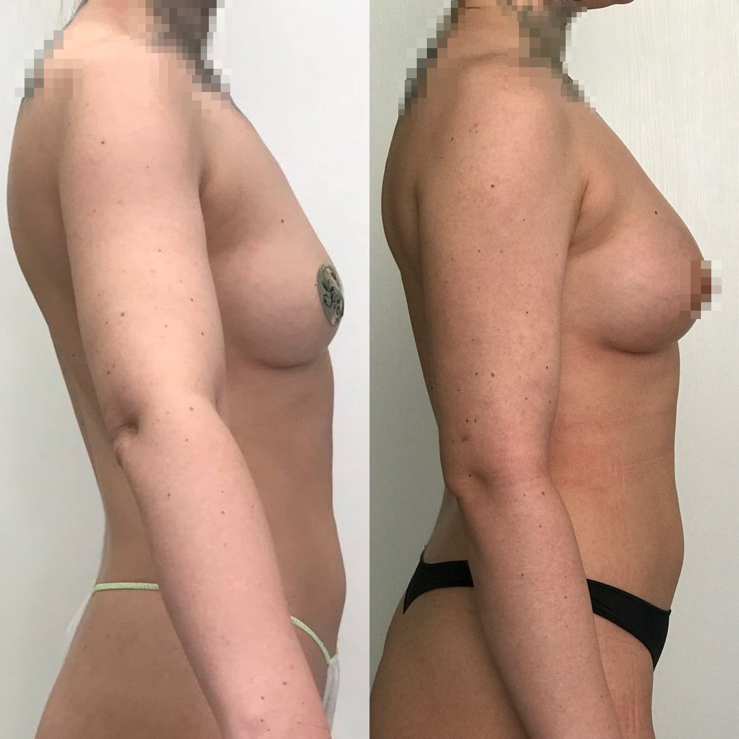 Липосакция плеч - фото до и после