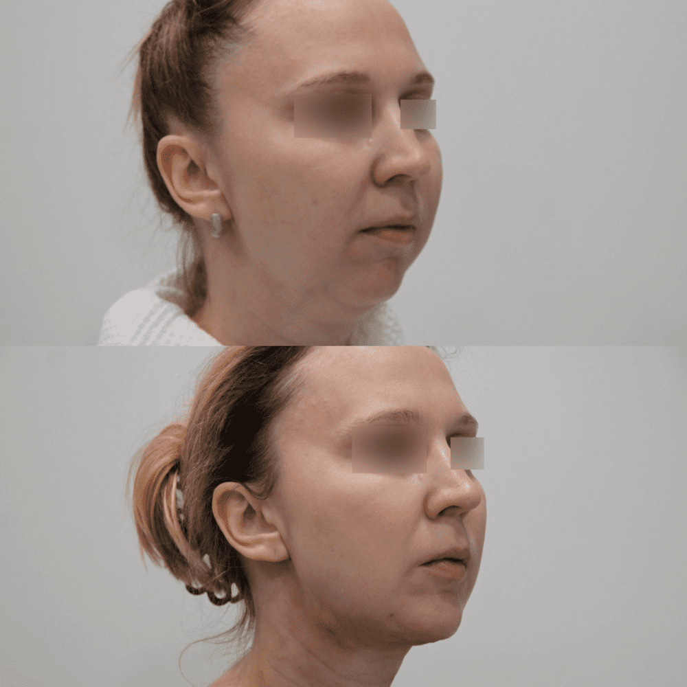 Липосакция шейно-подбородочный угол - фото до и после