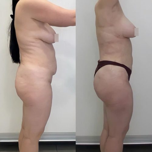 Липосакция спины - фото до и после
