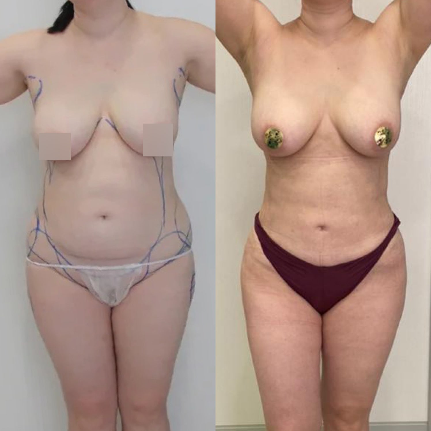 Липосакция спины - фото до и после