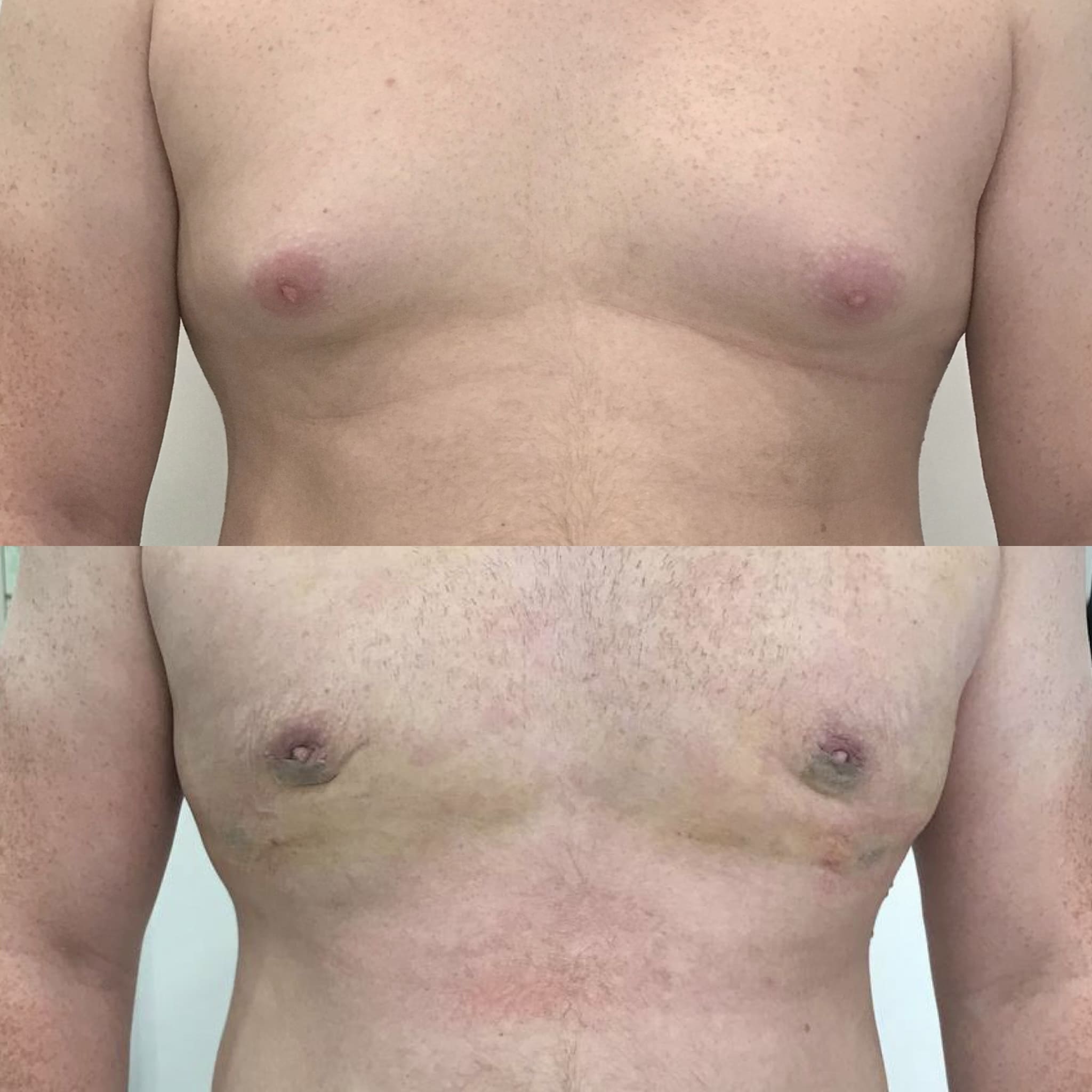 Липосакция при гинекомастии - фото до и после