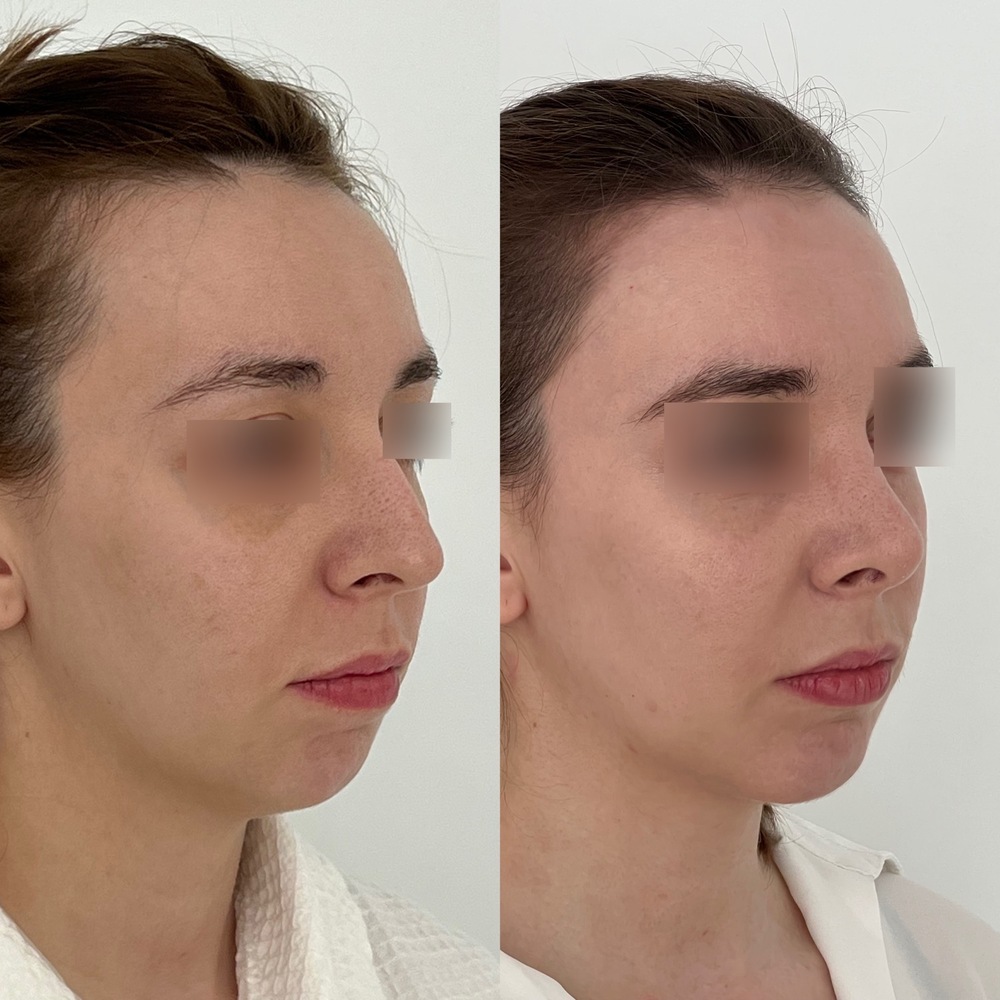 Коррекция подбородка (ментопластика) - фото до и после
