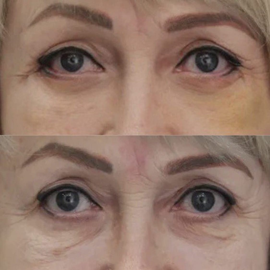 Нижняя блефаропластика с подтяжкой средней зоны лица (чек-лифтинг) - фото до и после