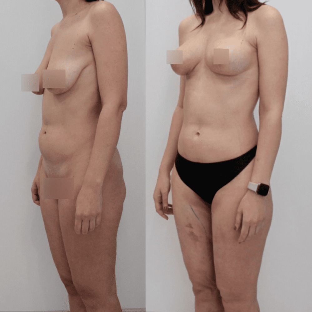 Липосакция колен - фото до и после
