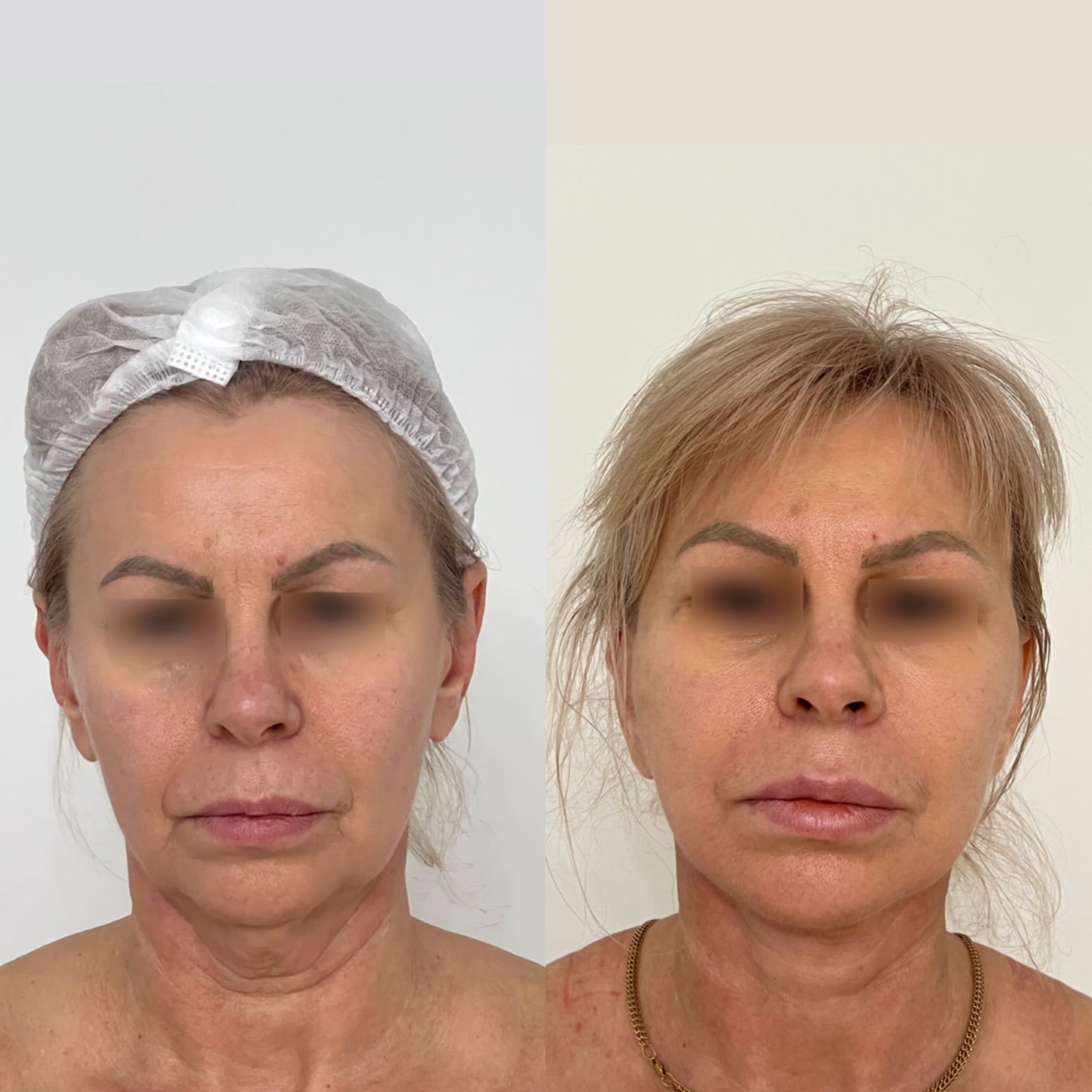 Липосакция лица - фото до и после