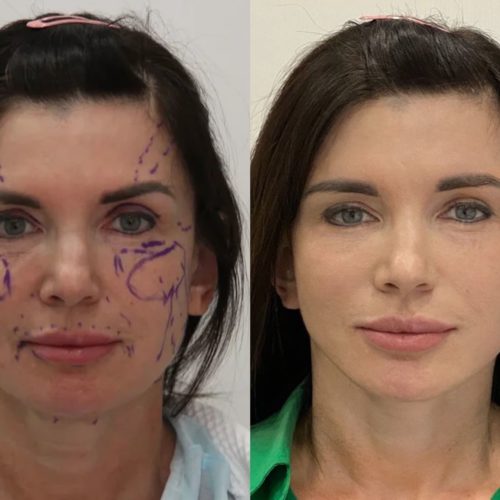 Липофилинг лица - фото до и после