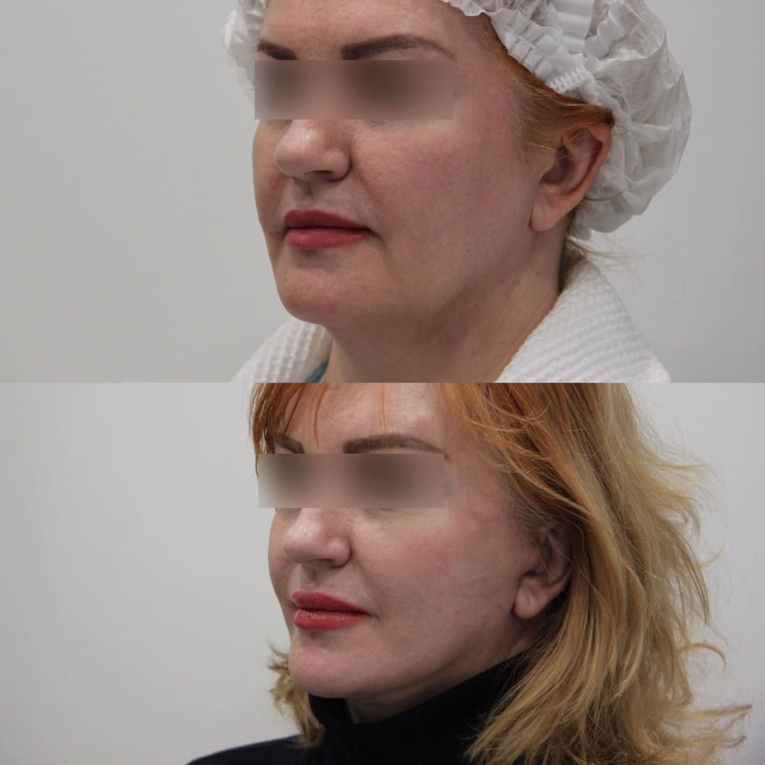 Липосакция лица - фото до и после