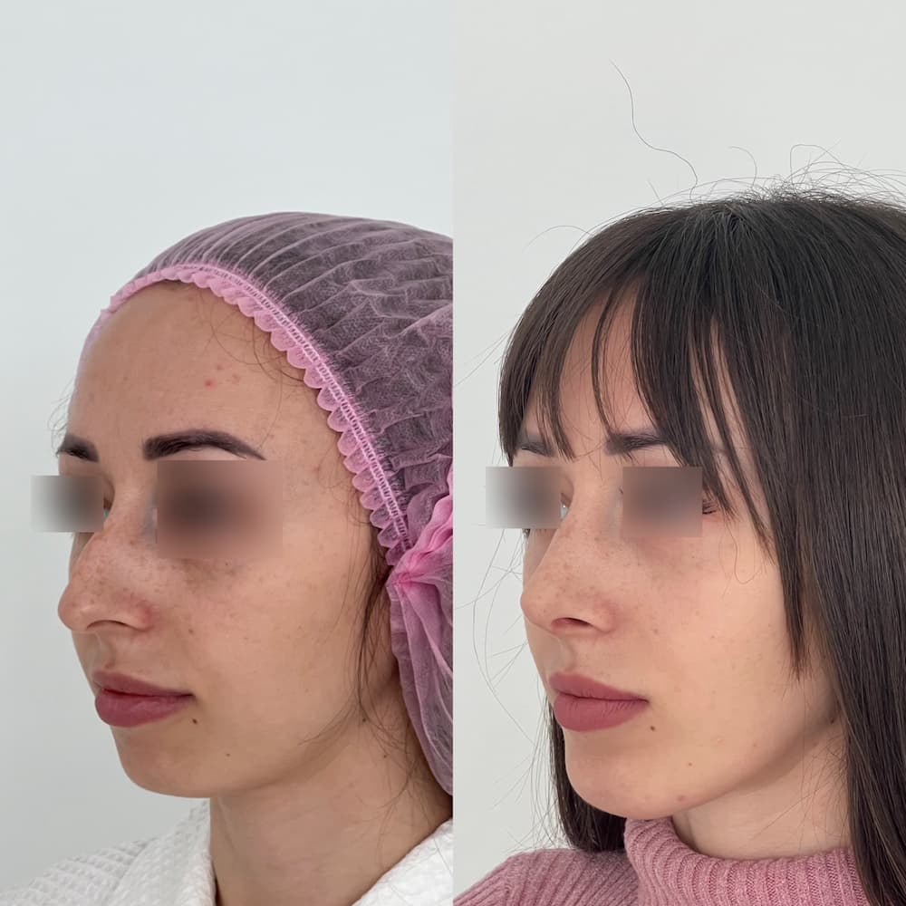 Коррекция подбородка (ментопластика) - фото до и после