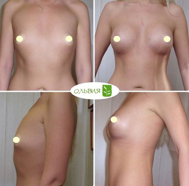 Трансаксиллярный доступ увеличения груди «под ключ» - фото до и после