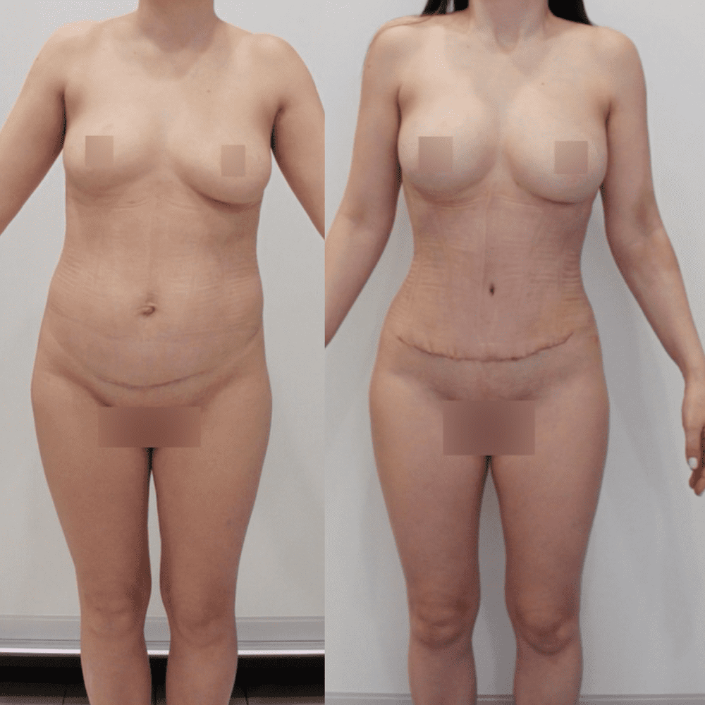 Создание тонкой талии без удаления рёбер и пластики живота по методу доктора Кудзаева - фото до и после