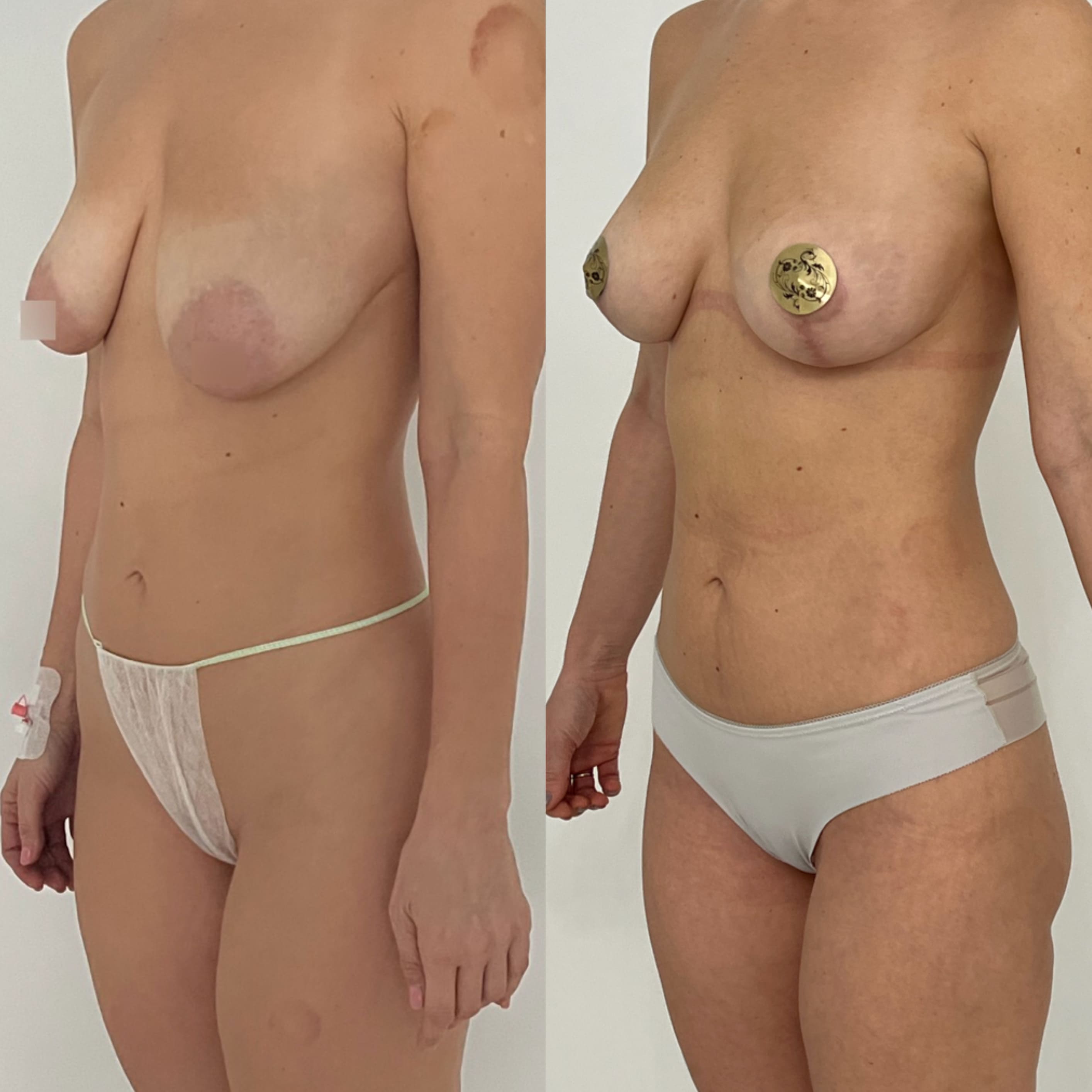Редукция молочной железы (уменьшение) - фото до и после