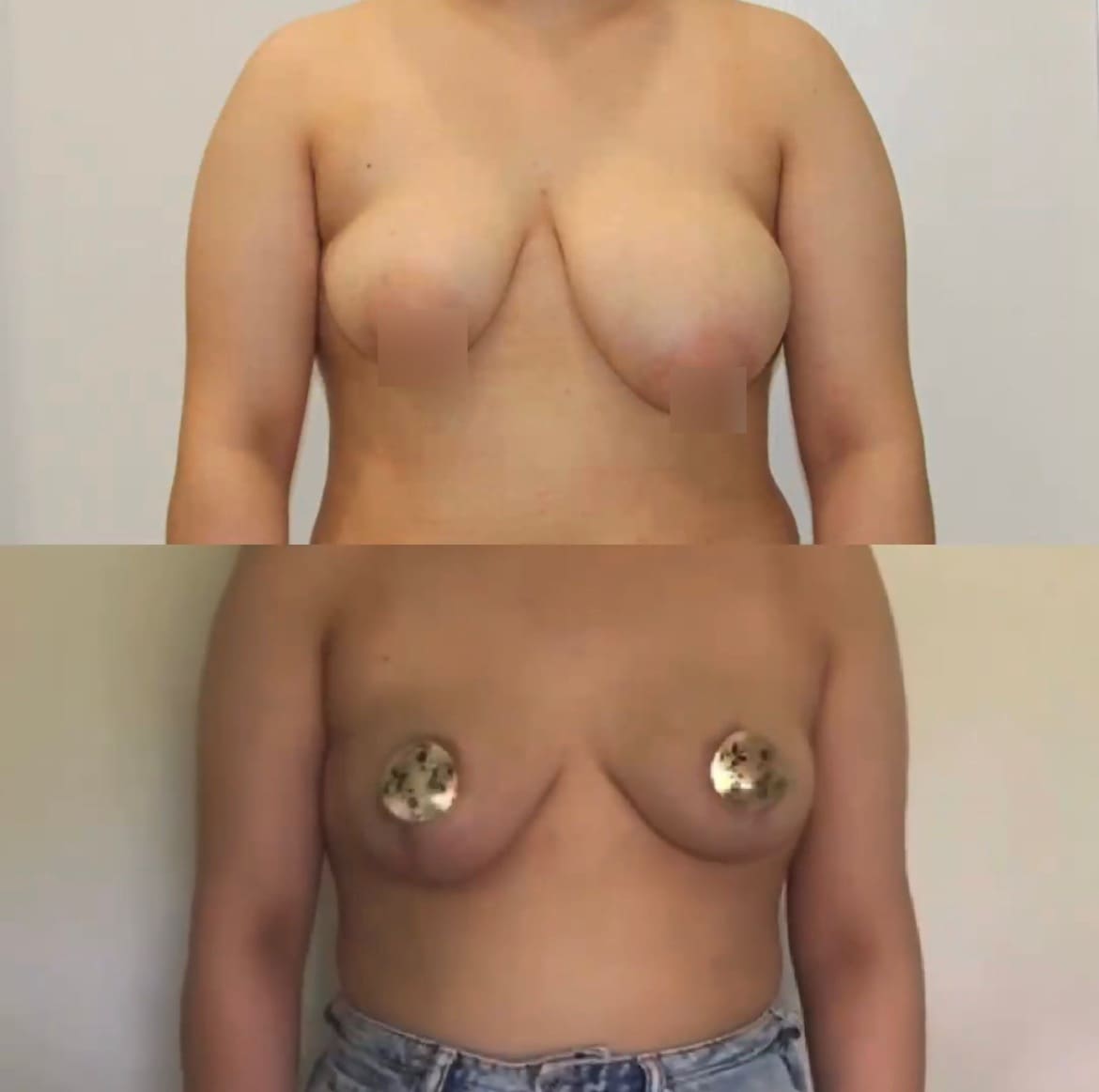 Редукция молочной железы (уменьшение) - фото до и после
