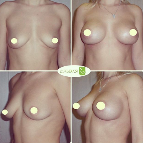Субмаммарный доступ увеличения груди «под ключ» - фото до и после