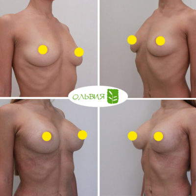 Трансаксиллярный доступ увеличения груди «под ключ» - фото до и после