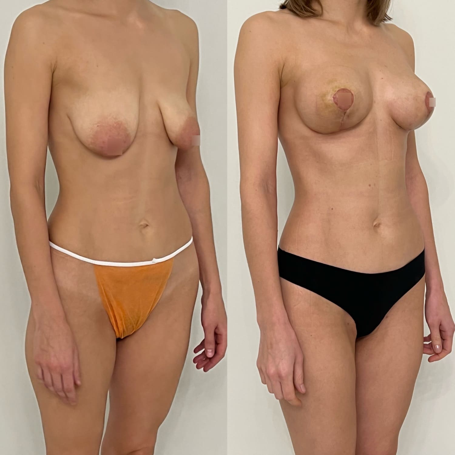 Липофилинг тубулярной груди с периареолярной подтяжкой - фото до и после