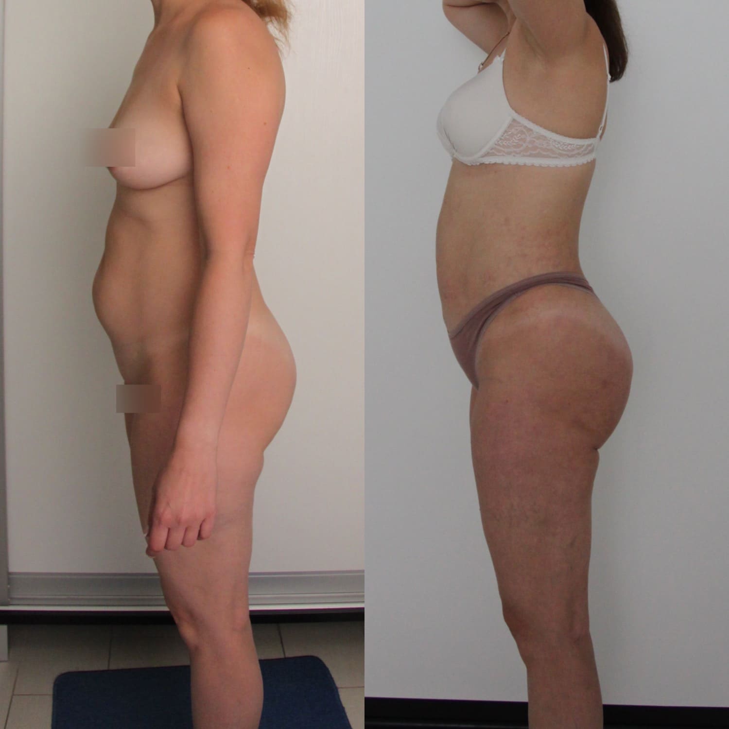 Липосакция колен - фото до и после