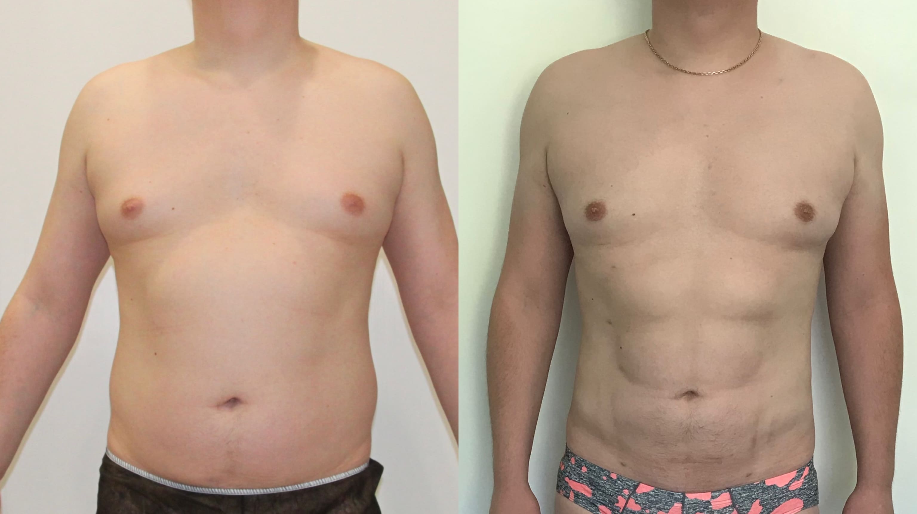 Мастэктомия при гинекомастии у мужчин (обе груди) - фото до и после