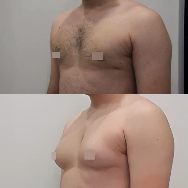 Мастэктомия при гинекомастии у мужчин (обе груди) - фото до и после