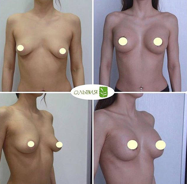 Коррекция тубулярной груди с имплантами «под ключ» - фото до и после
