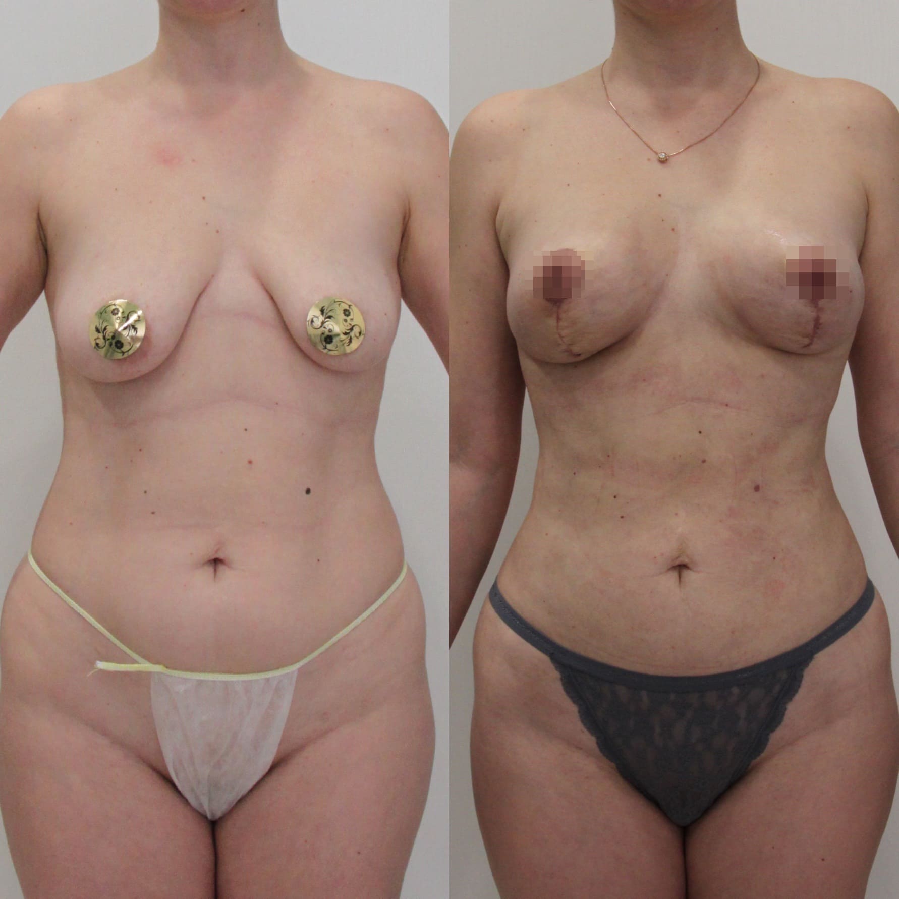 Подтяжка груди (мастопексия) - фото до и после