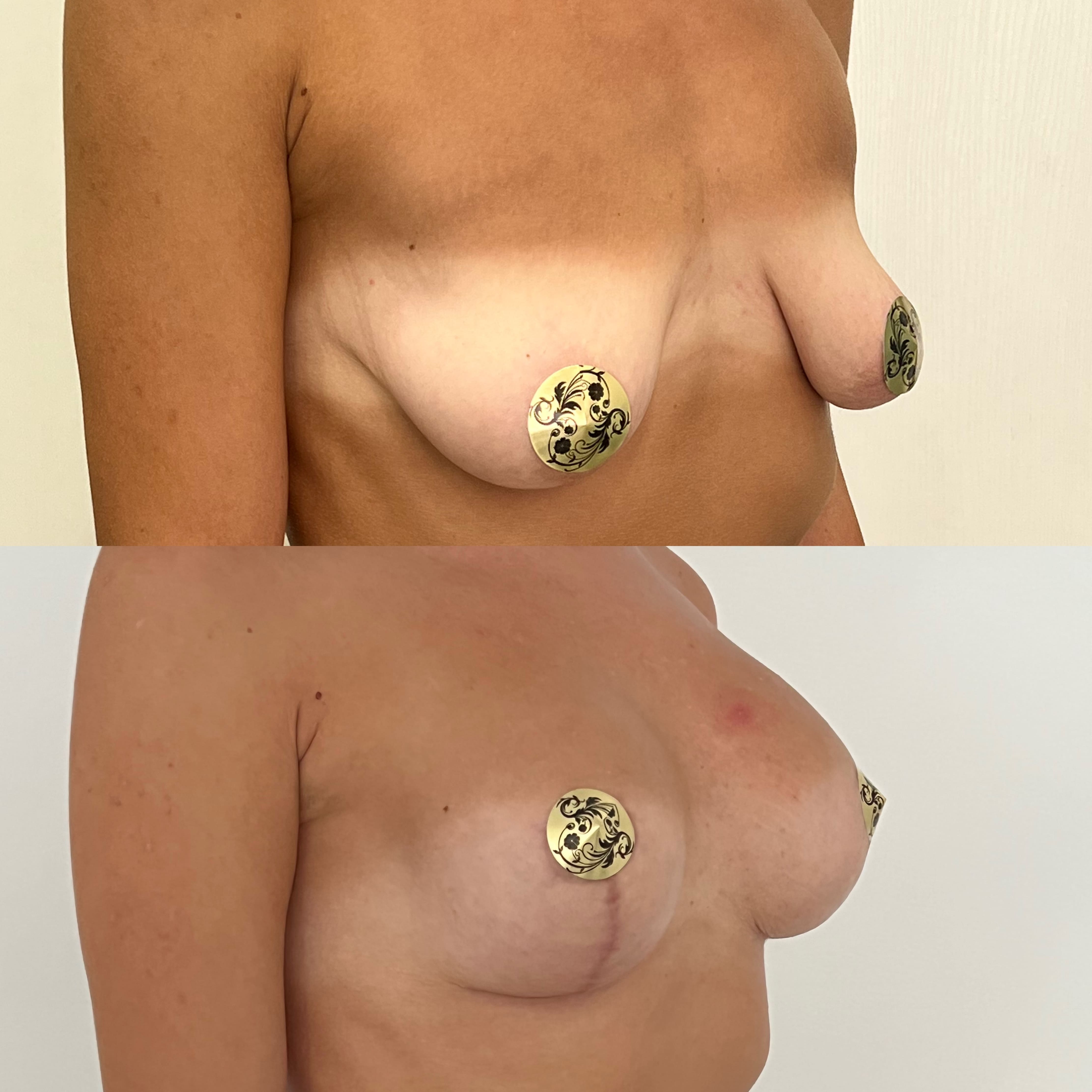Периареолярный доступ увеличения груди «под ключ» - фото до и после