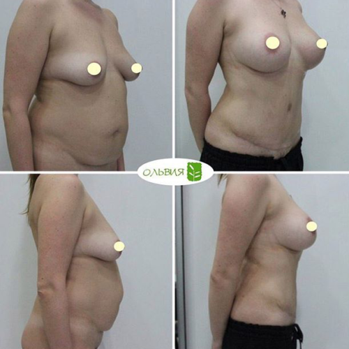 Периареолярный доступ увеличения груди «под ключ» - фото до и после