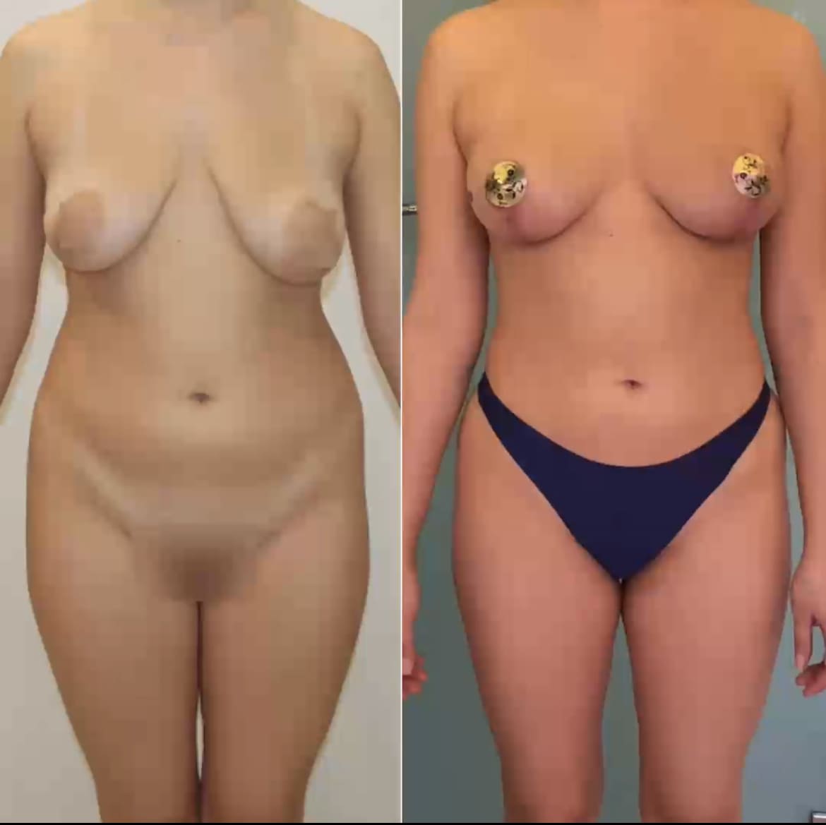 Липофилинг груди - фото до и после