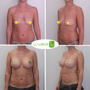 Подтяжка груди (мастопексия) - фото до и после