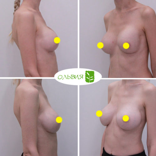Переустановка имплантов или удаление имплантов (обе груди без стоимости имплантов) - фото до и после