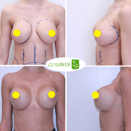 Переустановка имплантов или удаление имплантов (обе груди без стоимости имплантов) - фото до и после