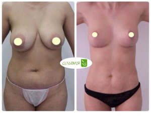 Коррекция тубулярной груди с имплантами «под ключ» - фото до и после