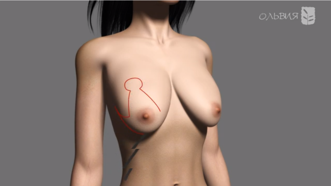 Подтяжка груди без имплантов (мастопексия) thumbnail