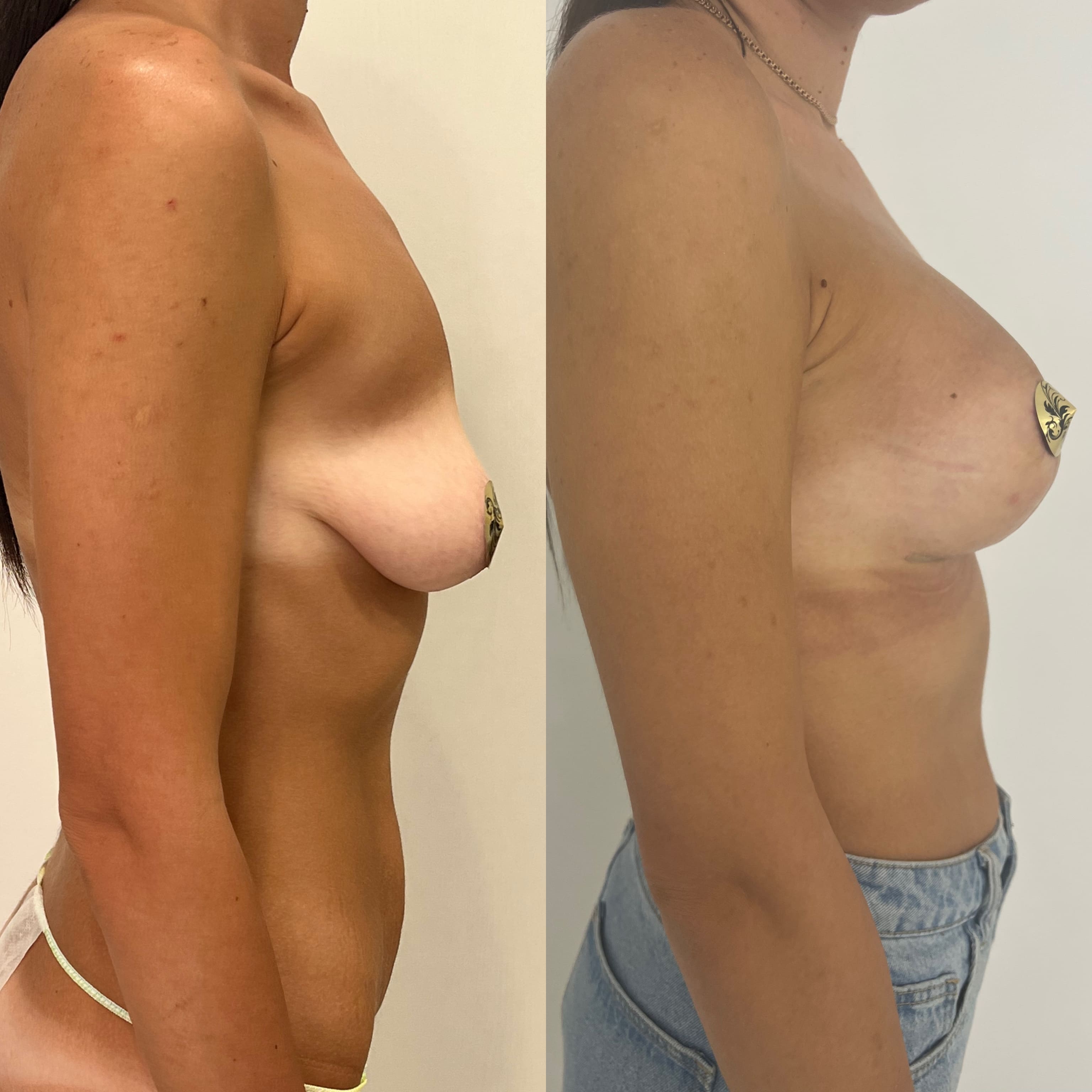 Периареолярная мастопексия - фото до и после